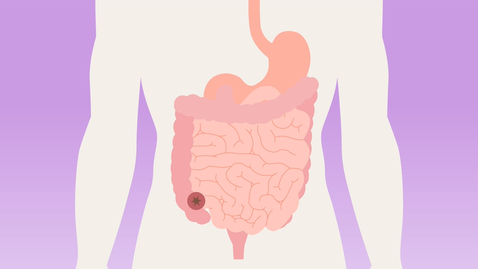 Thumbnail for Protektives Ileostoma